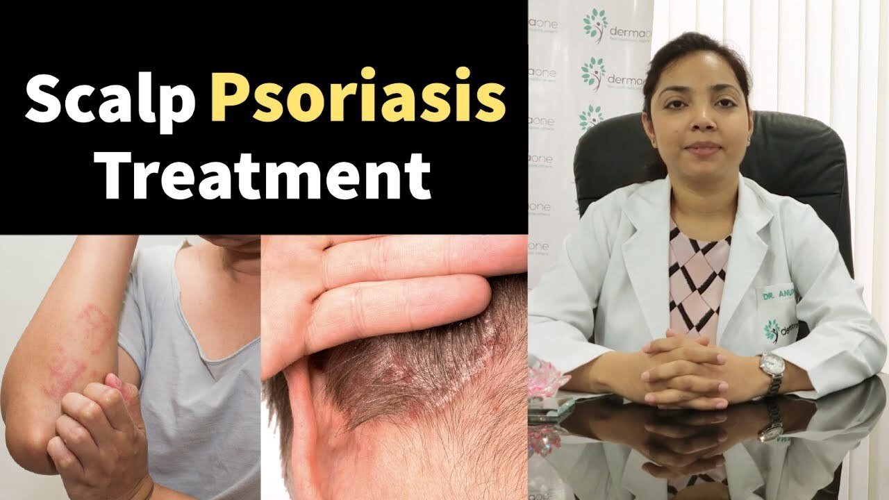 Psoriasis: Symptom och behandlingar